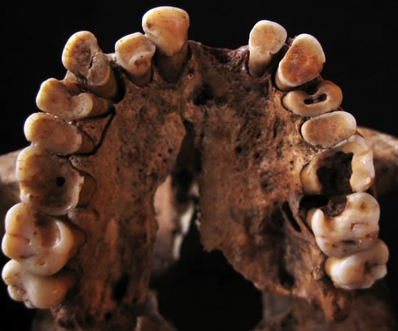 The teeth from skeletons unearthed in the Grotte des Pigeons cave in Morocco reveal evidence of extensive tooth decay and other dental problems, likely a result of their acorn-rich diet.