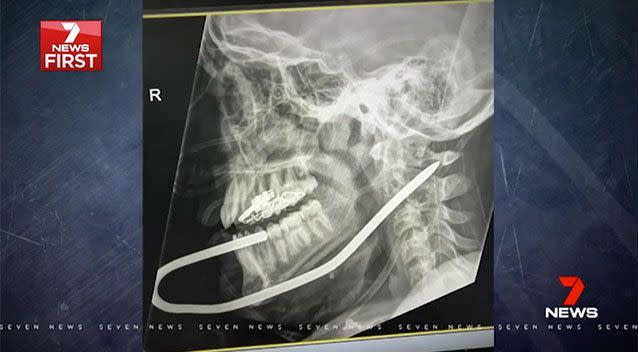 The 13-year-old ended up with a metal peg buried in his jaw and neck. Picture: 7 News