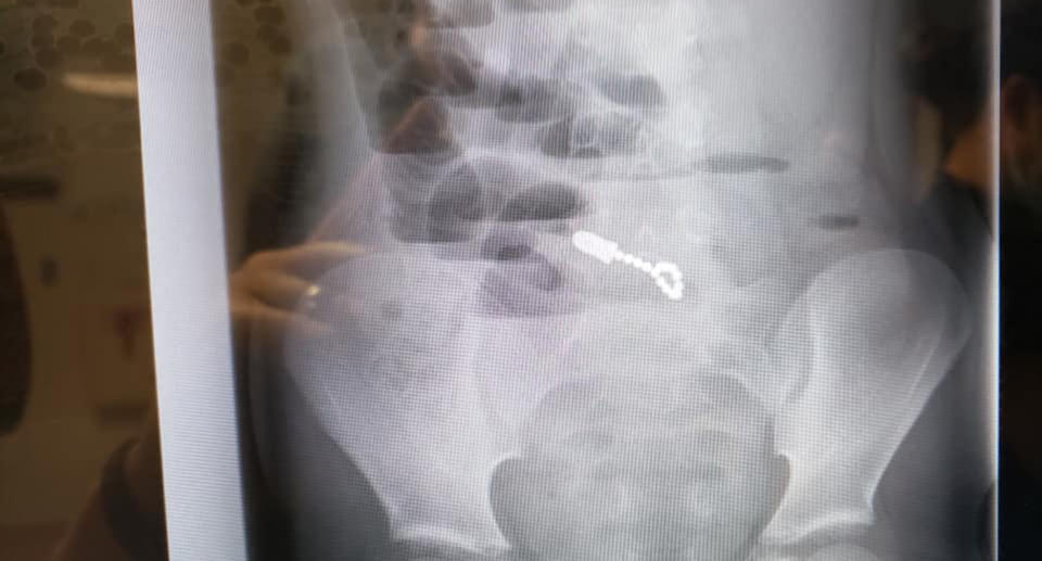 The Utah boy swallowed his brother's fidget toy that contained 14 magnets. 