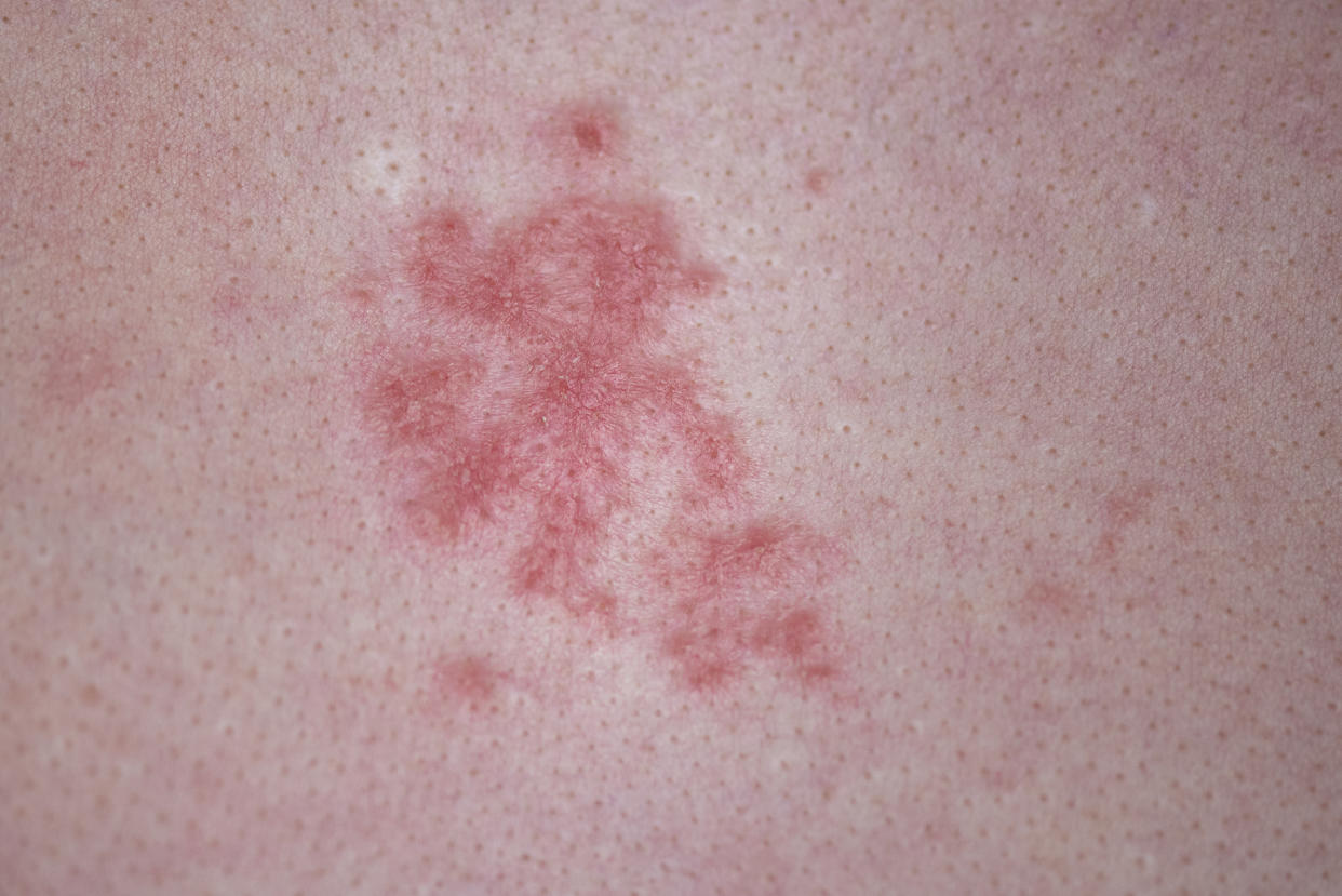 Human skin with red allergic spots, sores