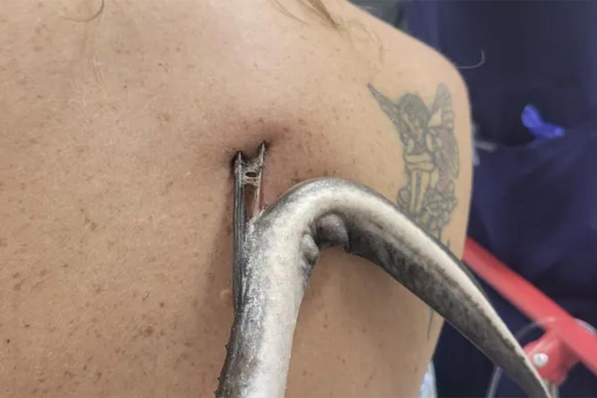 Fla. Woman Impaled in Back by Stingray Barb That Narrowly Missed Her Lungs:  'I'm Still in Shock