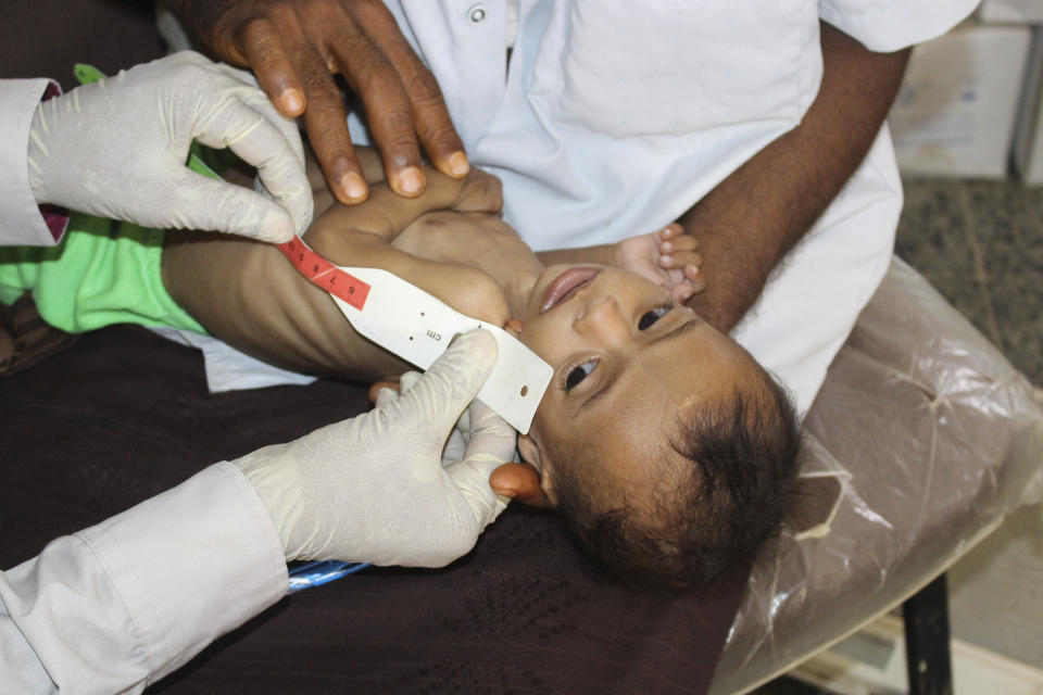 In this Sunday, June 14, 2020 photo, seven-month-old Issa Ibrahim Nasser is measured at a clinic in Deir Al-Hassi, At seven months old, Issa weighs only three kilos. Like him, hundreds of children suffer from acute severe malnutrition because of poverty and grinding conflict. Yemen. (AP Photo/Issa Al-Rajhi)