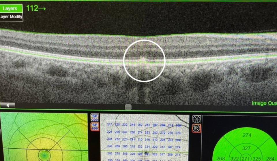 光學同調斷層掃描顯示，潘姓患者右眼視網膜黃斑部處有細胞排列不規則的病變。　（記者王正平攝）