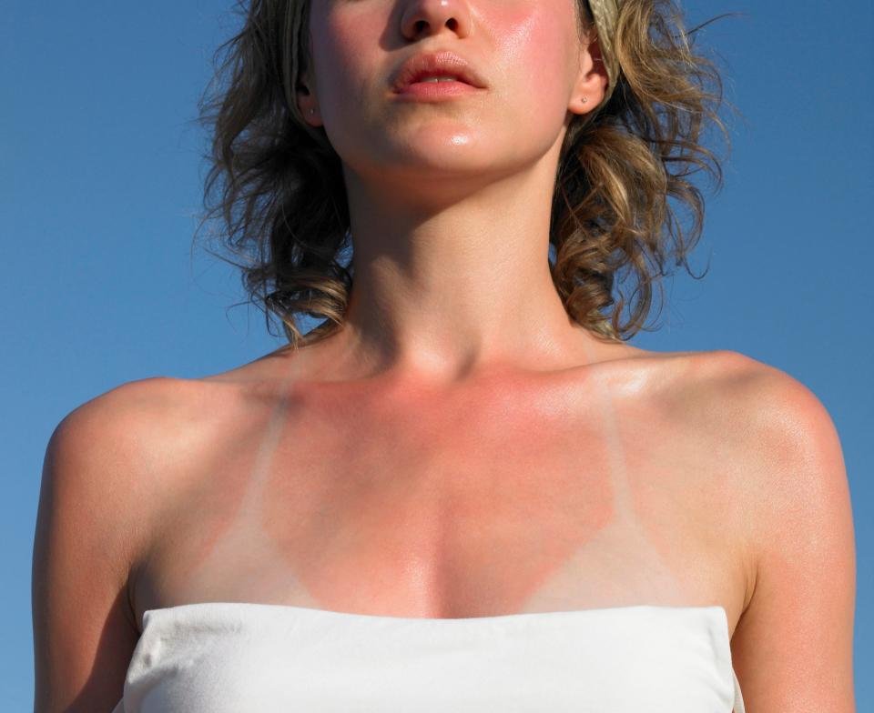 Ein Sonnenbrand kann schmerzhaft sein, ihr könnt ihn aber vermeiden. (Symbolbild) - Copyright: Getty Images / Dougal Waters