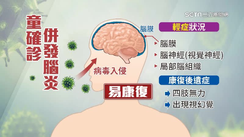 兒童確診併發腦炎，若是病毒入侵腦膜、腦神經局部組織，雖然易康復，但後遺症包括四肢無力、視幻覺。