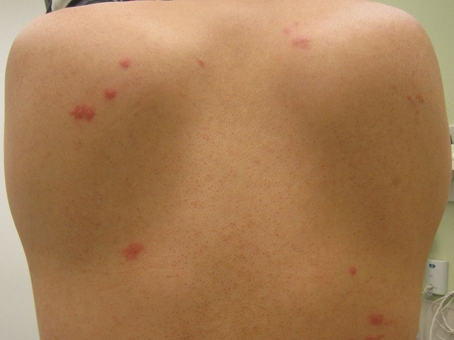 Spider bites - Diagnosis & treatment - Mayo Clinic