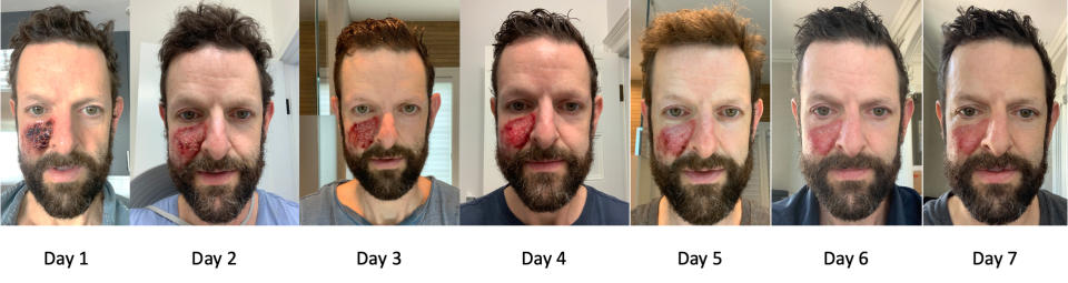 These photos show the recovery in the days after the treatment ended.  (Courtesy Jeff Karp)