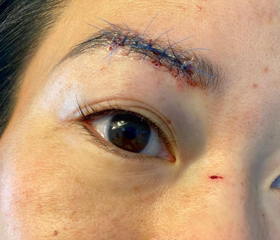 Ms Yi received several stitches after being struck above her right eye (Twitter.com/MurtzJaffer)