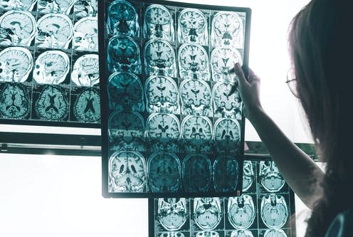 <span class="caption">More research is needed to prove the drug slows cognitive decline.</span> <span class="attribution"><a class="link " href="https://www.shutterstock.com/image-photo/alzheimers-disease-on-mri-677117191" rel="nofollow noopener" target="_blank" data-ylk="slk:Atthapon Raksthaput/ Shutterstock;elm:context_link;itc:0;sec:content-canvas">Atthapon Raksthaput/ Shutterstock</a></span>