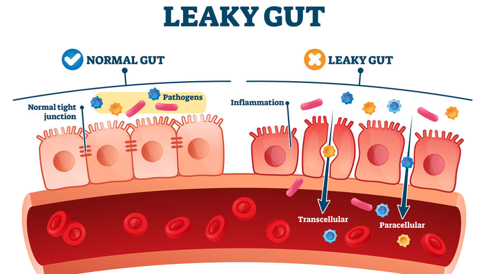 Illustration showing the way your gut lining can become 