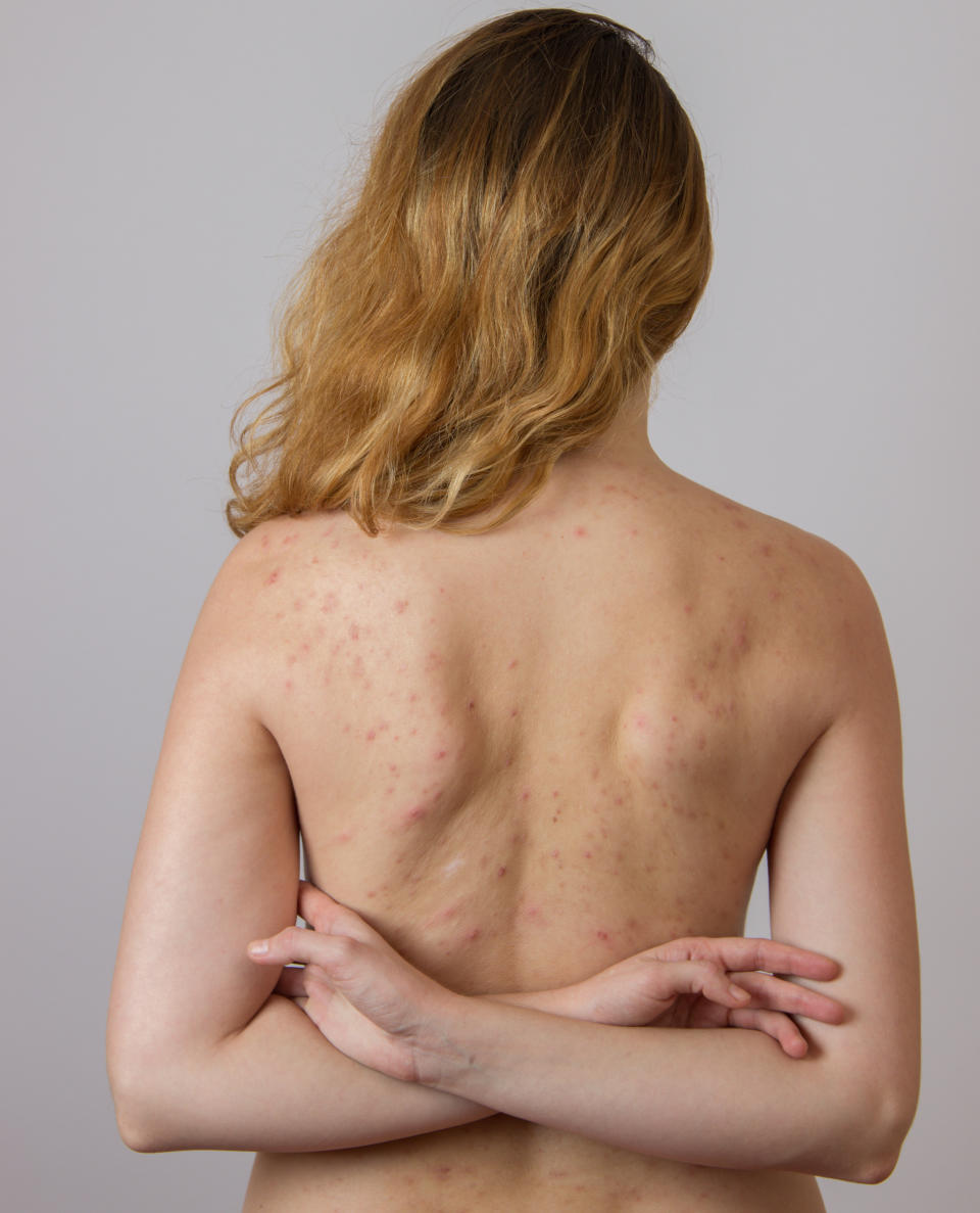 So this is *actually* why we get acne on our backs