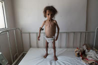 <p>Al Joumhouri Hospital, Saada City, Yemen, April 24, 2017: Batool Ali, aged 6, stands on a hospital bed in Saada. Batool suffers from severe acute malnutrition. At the time the photograph was taken, Batool weighed only 15.8 kgs and only able to ingest liquids. The small pouch attached to her right arm is a local rural potion wrapped in a bag and used to ward off snakes whilst families take overnight shelter in homemade holes in the desert. During the night, many families leave their houses for the desert shelters in fear of airstrikes on their homes. (Photograph by Giles Clarke for UN OCHA/Getty Images) </p>