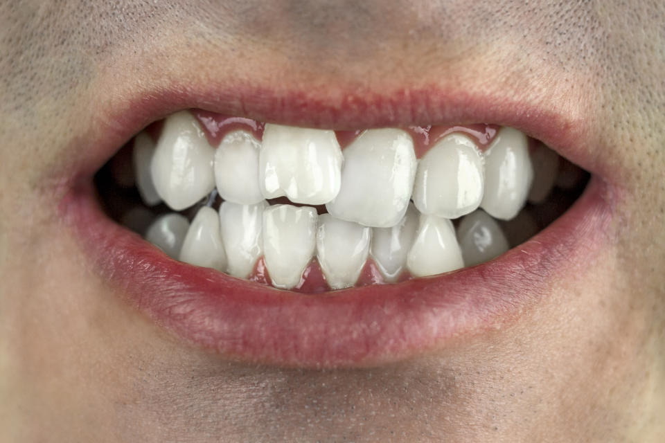 Cuando los dientes están apiñados o torcidos, hay más oportunidades para que las bacterias crezcan y la placa se desarrolle.(Foto: Getty)