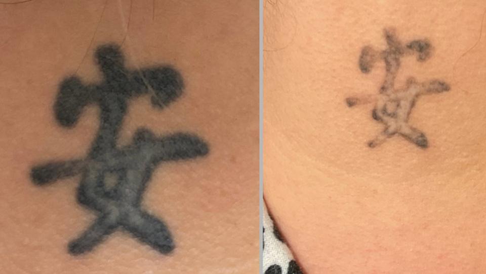 Belle Mia Laser and Skincare Center in Asheville offers laser tattoo removal services.