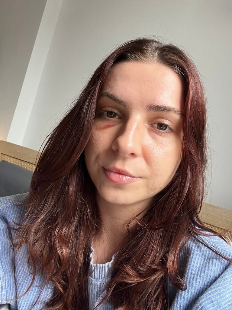 Mikayla Toninato, 27, from Brooklyn, was punched in the face Monday afternoon by a man over six feet tall on the corner of 14th Street and Fifth Avenue. She went to the emergency room Tuesday and was told she had a concussion. Courtesy of Mikayla Toninato