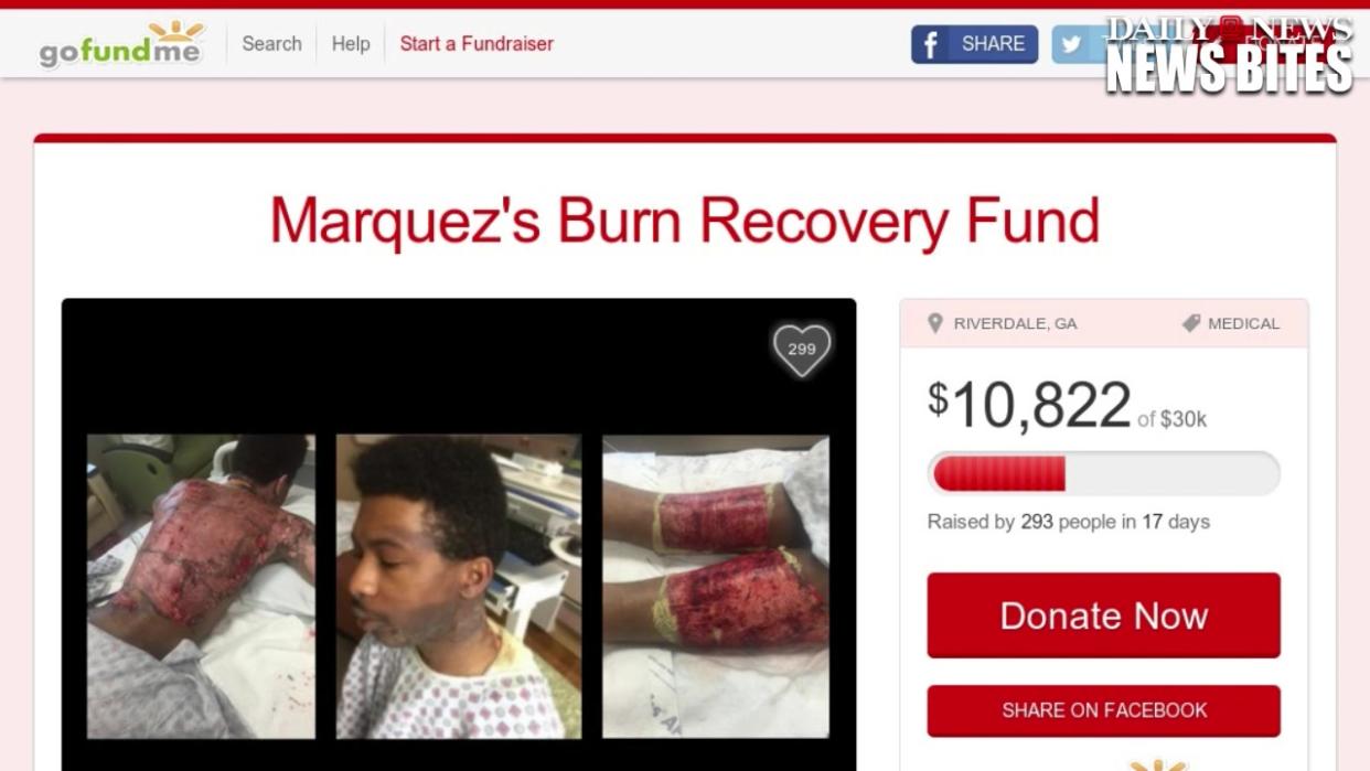 Gay Couple Severely Burned After Mom's Boyfriend Throws Boiling Water on Th