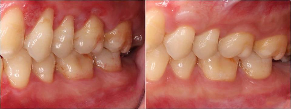 術前因牙齦退縮，牙齒明顯變長(左圖)；透過「皮下結締組織移植術」執行牙根覆蓋手術，牙齦長回正常的厚度、高度。(右圖)