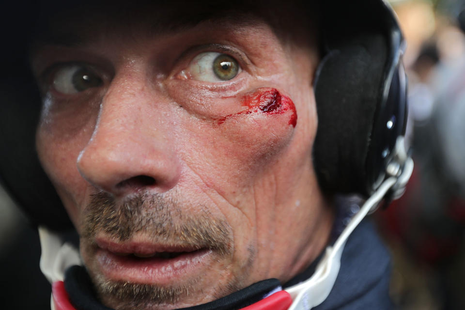 <p>A white supremacist is cut below his eye during clashes with counter-protesters at Lee Park after the “Unite the Right” rally was declared an unlawful gathering Aug. 12, 2017 in Charlottesville, Va. (Photo: Chip Somodevilla/Getty Images) </p>