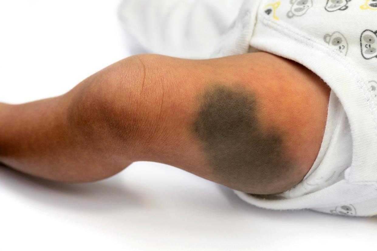 A blue spot birthmark is very common in babies, especially among babies of African or Asian descent. (NHS)