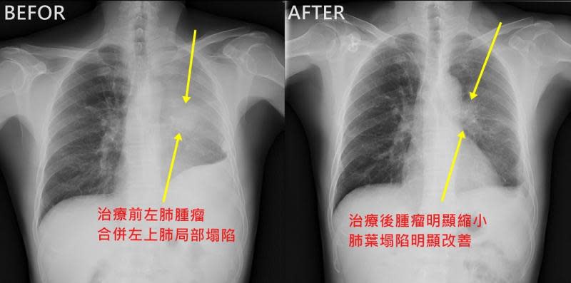 國健署補助　羅東博愛醫院力推肺癌篩檢