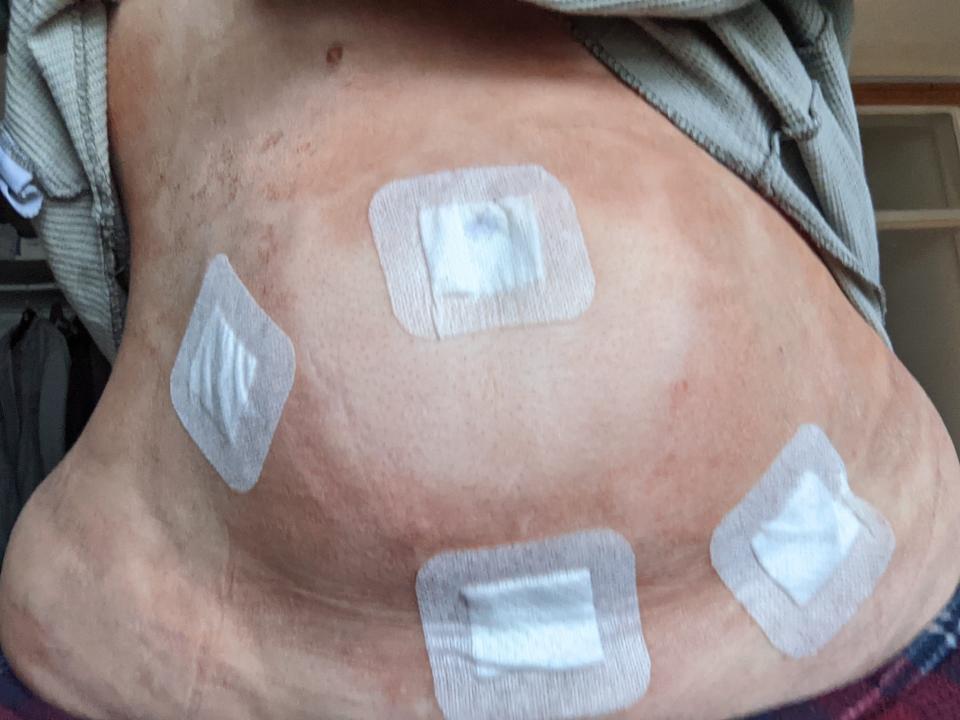 A person's abdomen exposed with many bandages on it.