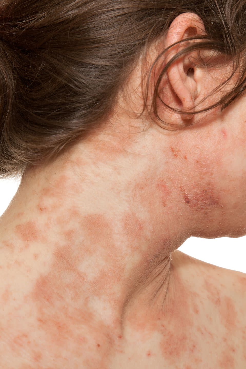 1) Atopic Dermatitis: Persistent Red Patches