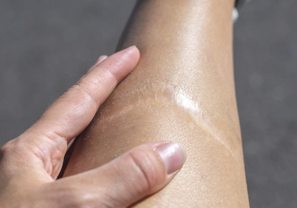 A close-up image of a hand gently touching a healed scar on a person's leg