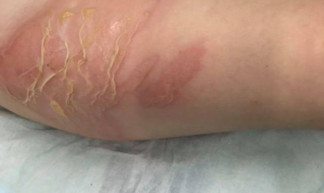 Parents urged to never give kids hot water bottles after 'alarming' spike  in number suffering serious burns