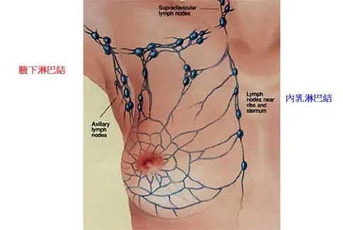 乳癌患者經切片檢查，常可發現內乳淋巴結和腋下淋巴結有回流受阻、被癌細胞感染的情況。（圖片提供／彰化基督教醫院）