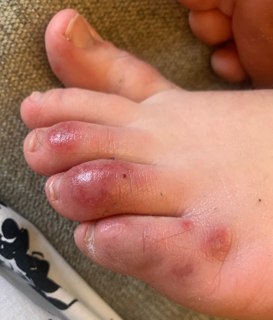 This April 6, 2020 photo provided by Northwestern University shows discoloration on a teenage patient's toes three days after the onset of the condition informally called "COVID toes." The red, sore and sometimes itchy swellings on toes look like chilblains, something doctors normally see on the feet and hands of people who’ve spent a long time outdoors in the cold. (Courtesy of Dr. Amy Paller/Northwestern University via AP)