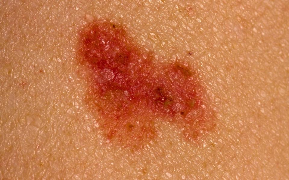 The most common non-melanoma skin cancer is basal cell carcinoma, a slow-growing skin cancer that does not tend to spread
