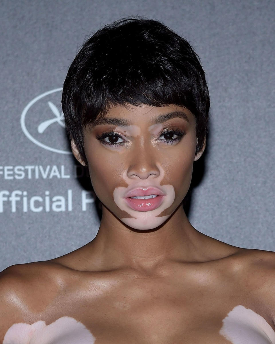 Winnie Harlow