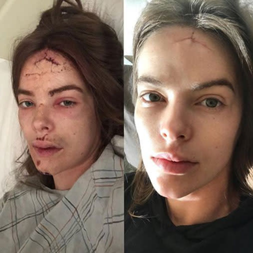 Robyn shared shocking snaps of her injuries, with the pic on the left from a few months ago, and the one on the right taken last week. Photo: Instagram/robynlawley