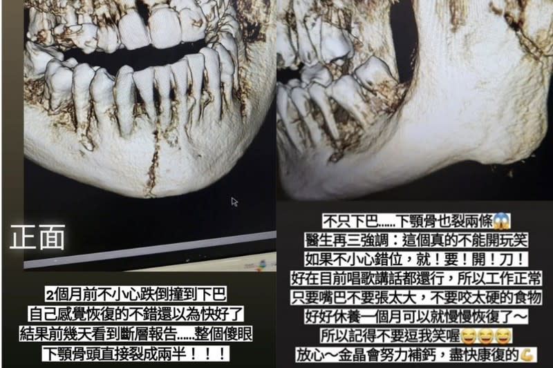 謝金晶曝光自己骨裂照片。（圖／翻攝自IG）