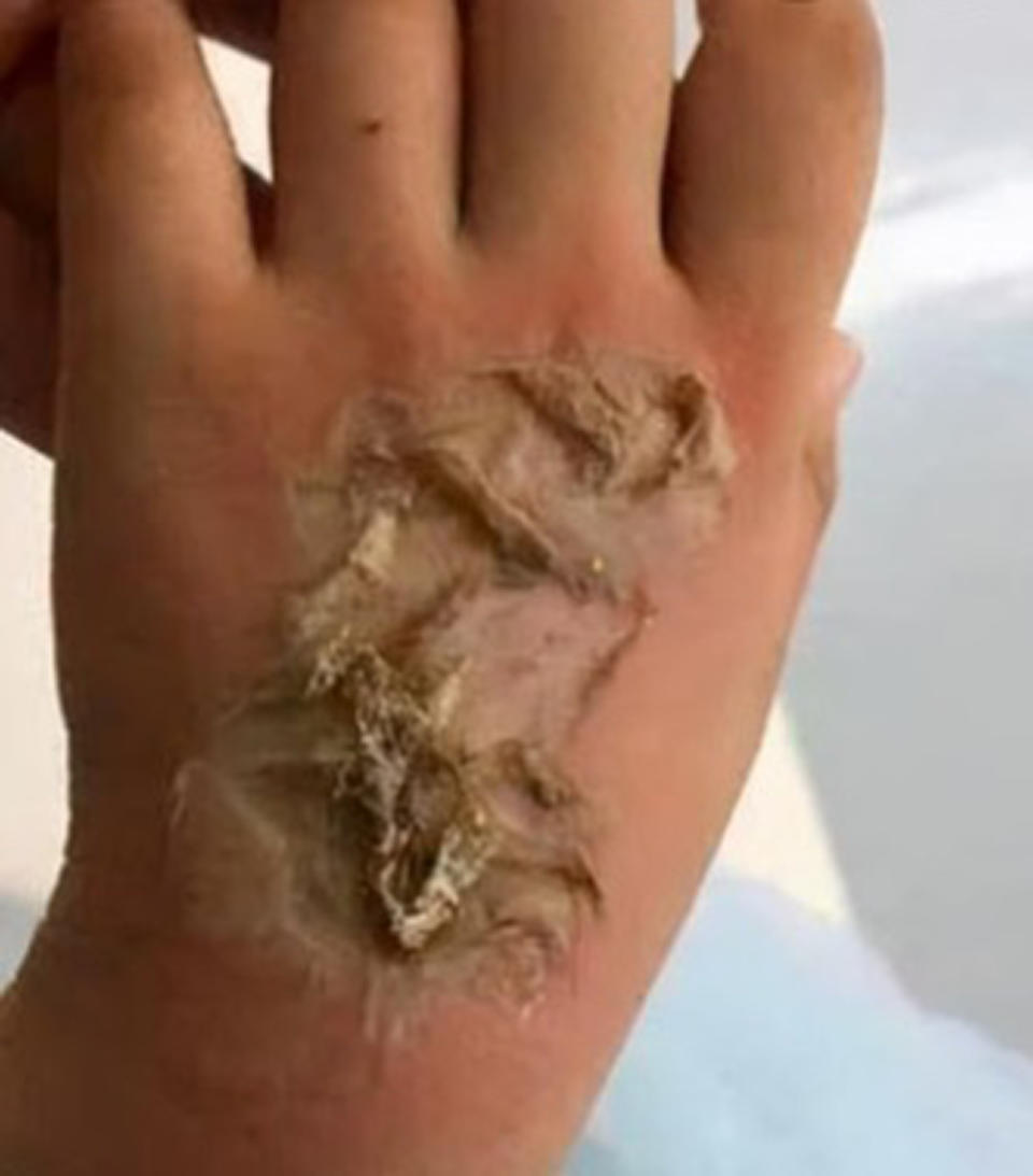 Four-year-old girl's severely burned hand after the smartwatch suddenly ignited in Quanzhou, China. Source: AsiaWire/Australscope