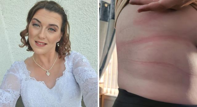 Mum's rare allergy means she can't wear jeans or bra - even her wedding  dress left her with rash - Wales Online
