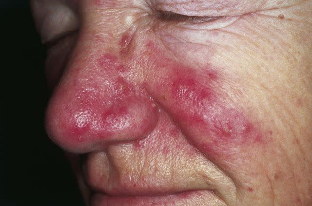 <p>Wikimedia Commons/CC-BY-2.0</p> Rosacea