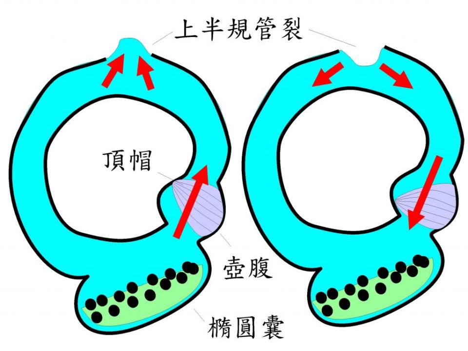 當內淋巴液壓力變化，傳到上半規管裂縫處，膜性半規管會向外膨出（圖左），再向內凹陷時（圖右），內淋巴液來回流動，會扭曲壺腹處的頂帽，使患者以為頭部姿勢正在改變。　↑當內淋巴液壓力變化，傳到上半規管裂縫處，膜性半規管會向外膨出（圖左），再向內凹陷時（圖右），內淋巴液來回流動，會扭曲壺腹處的頂帽，使患者以為頭部姿勢正在改變。