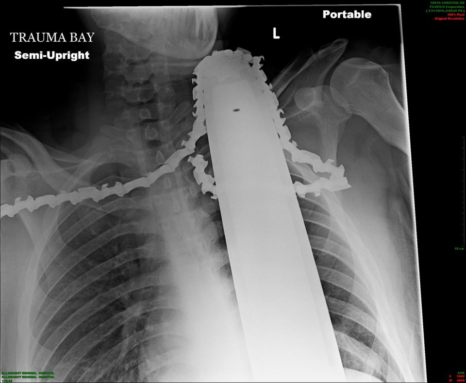 A chest x-ray shows the chainsaw that was embedded in James Valentine's neck and shoulder, courtesy of the Allegheny Health Network, received April 1, 2014. Valentine, 21, was part of a crew pruning trees on Monday afternoon when his saw suddenly kicked back and the blade sliced into him. His co-workers brought him down from the tree and he was taken to Allegheny General Hospital in Pittsburgh, Pennsylvania. REUTERS/Allegheny Health Network/Handout via Reuters (UNITED STATES - Tags: DISASTER HEALTH) NO SALES. NO ARCHIVES. FOR EDITORIAL USE ONLY. NOT FOR SALE FOR MARKETING OR ADVERTISING CAMPAIGNS. MANDATORY CREDIT. ATTENTION EDITORS - THIS PICTURE WAS PROVIDED BY A THIRD PARTY. REUTERS IS UNABLE TO INDEPENDENTLY VERIFY THE AUTHENTICITY, CONTENT, LOCATION OR DATE OF THIS IMAGE. THIS PICTURE IS DISTRIBUTED EXACTLY AS RECEIVED BY REUTERS, AS A SERVICE TO CLIENTS