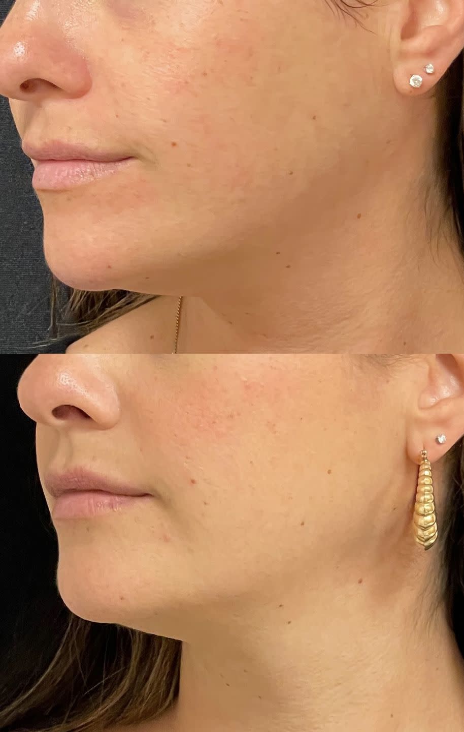 jaw filler before and after