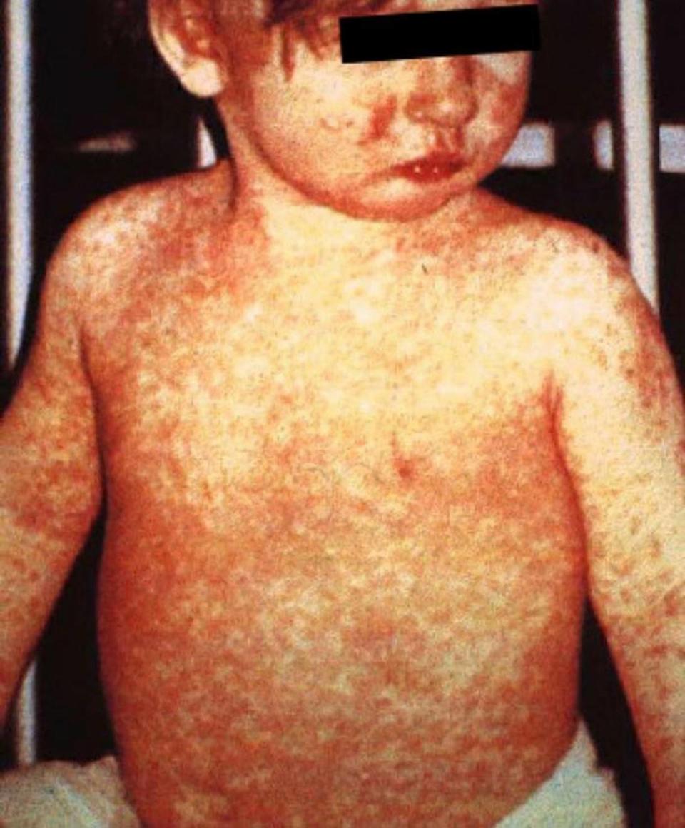 The rash is the best-known symptom of measles, but the patients first develop a fever, cough and runny nose, not unlike the flu.