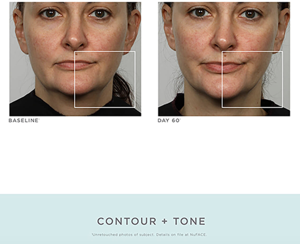 NuFACE Trinity Facial Toning Device Results (Photo via SkinStore)