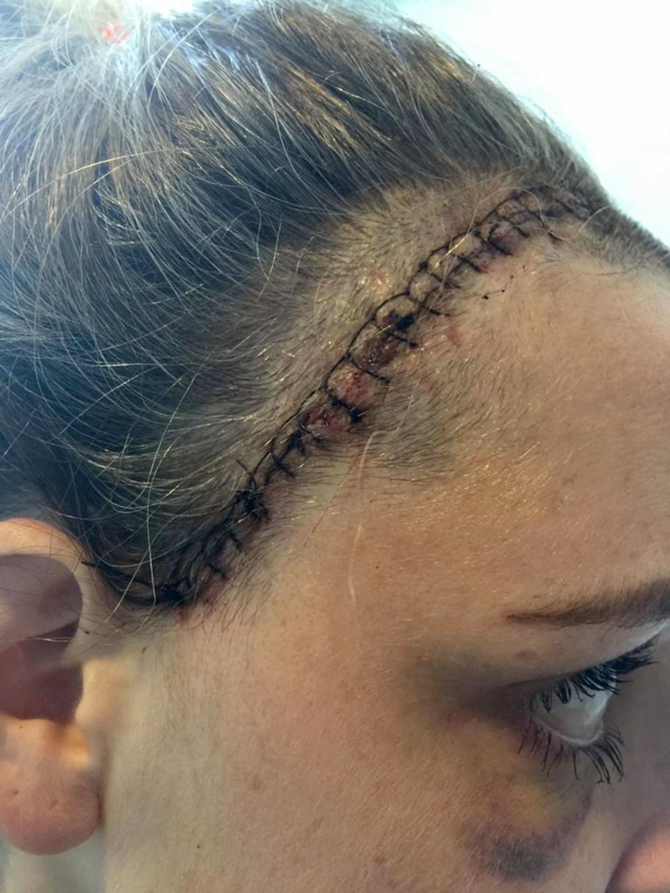 The stitches Emily had after surgery [Photo: Caters]