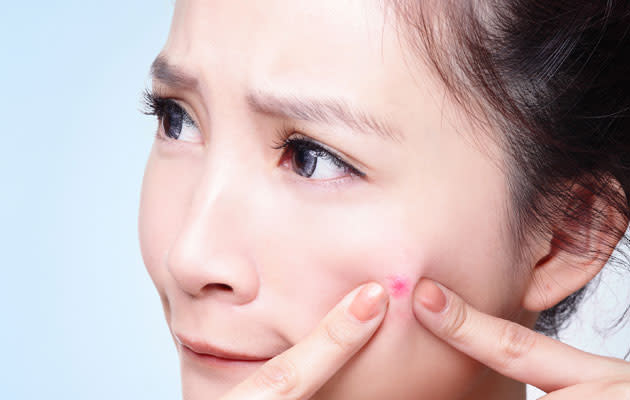 Acne affects over 80 per cent of all adolescents. (Thinkstock photo)
