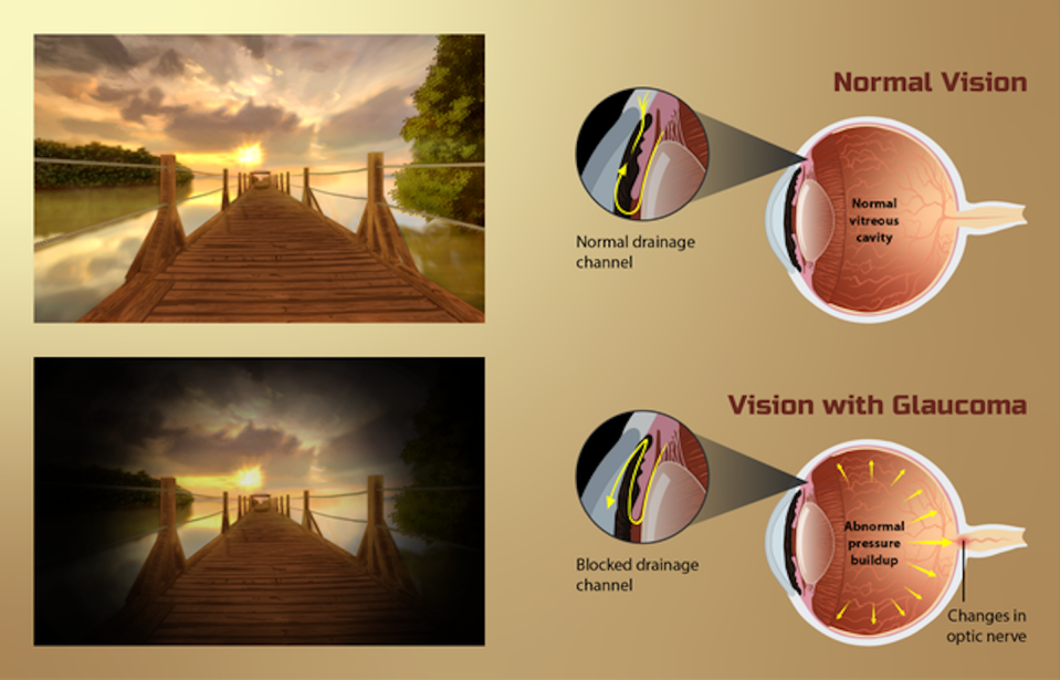 Comparativa de un sujeto con visión normal (imagen superior) y otro con glaucoma (inferior) Wikimedia Commons, <a href="http://creativecommons.org/licenses/by/4.0/" rel="nofollow noopener" target="_blank" data-ylk="slk:CC BY;elm:context_link;itc:0;sec:content-canvas" class="link ">CC BY</a>