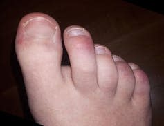 <span class="caption">About half of children with MIS-C develop rashes. This COVID-19 rash appeared on the toes.</span> <span class="attribution"><a class="link " href="https://commons.wikimedia.org/wiki/File:Alteraci%C3%B3n_dermatol%C3%B3gica_en_los_dedos_de_los_pies_provocada_por_coronavirus.jpg" rel="nofollow noopener" target="_blank" data-ylk="slk:Marpu98/Wikimedia;elm:context_link;itc:0;sec:content-canvas">Marpu98/Wikimedia</a>, <a class="link " href="http://creativecommons.org/licenses/by-sa/4.0/" rel="nofollow noopener" target="_blank" data-ylk="slk:CC BY-SA;elm:context_link;itc:0;sec:content-canvas">CC BY-SA</a></span>