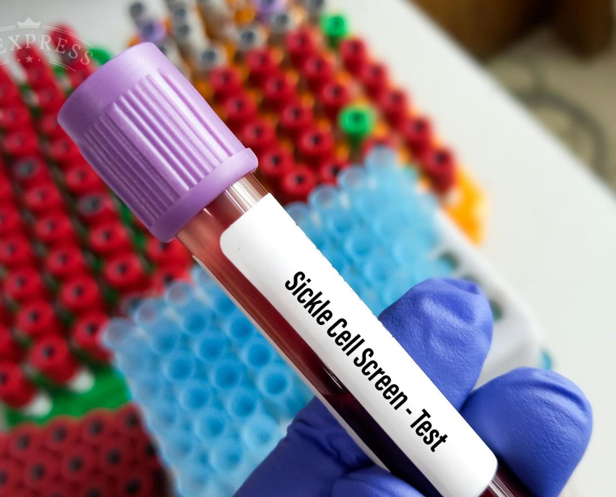 Sickle cell disease can lead to a stroke − proper screening can help. <a href="https://www.gettyimages.com/detail/photo/blood-sample-tube-with-blood-for-sickle-cell-screen-royalty-free-image/1397852601?phrase=sickle%2Bcell%2Bdisease" rel="nofollow noopener" target="_blank" data-ylk="slk:Md Babul Hosen/Getty Images;elm:context_link;itc:0;sec:content-canvas" class="link ">Md Babul Hosen/Getty Images</a>