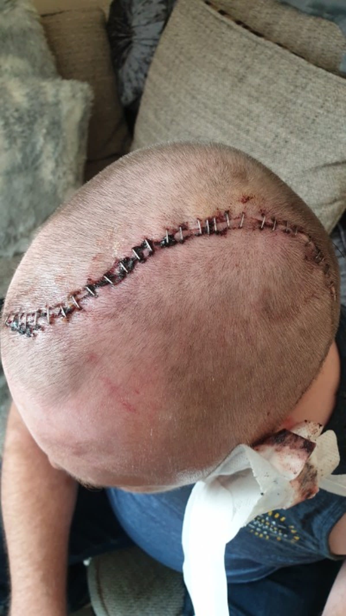 He has recently had surgery to put a titanium plate in his head to replace where his skull should have been (North Yorkshire Police)