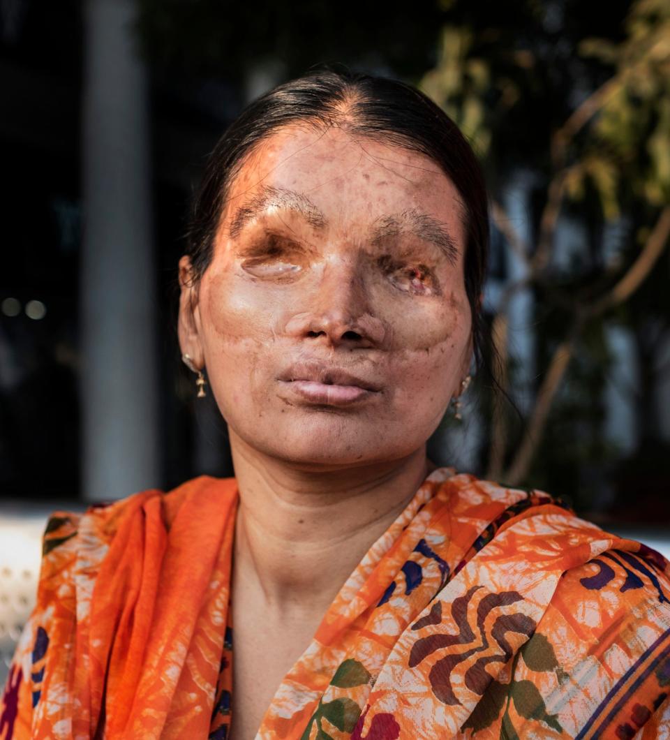 Anumukherjee was blinded in an acid attack