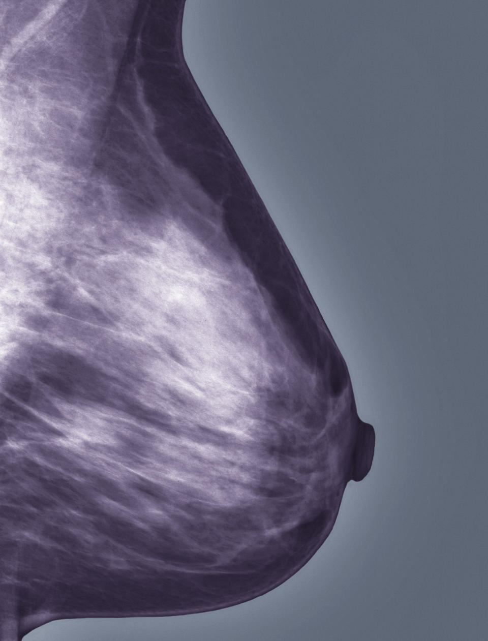 Mammogram image